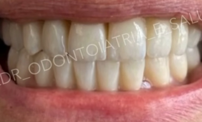 Risultato finale del sorriso