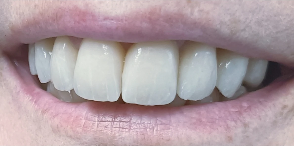 Risultato finale della riabilitazione complessa in ceramica
