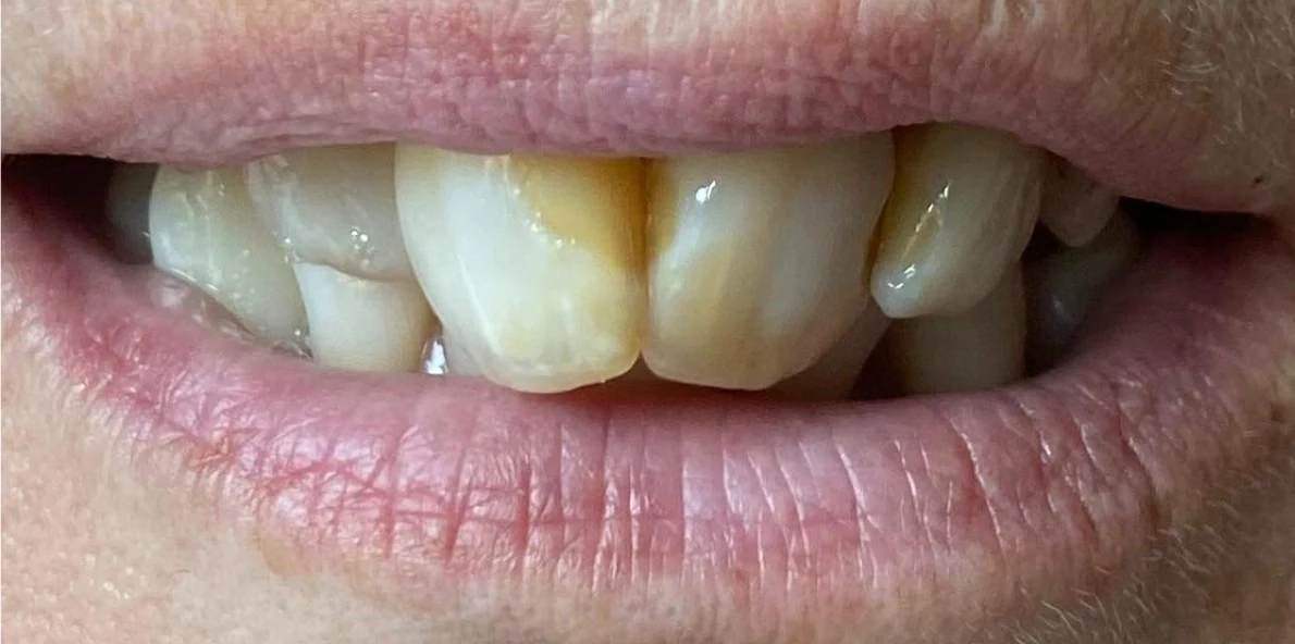 Situazione iniziale prima della riabilitazione complessa in ceramica
