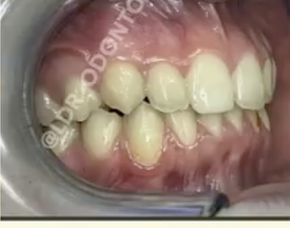 Risultato finale dopo la correzione ortodontica di deep bite e overjet
