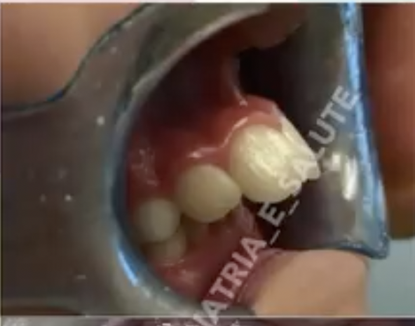 Situazione iniziale prima della correzione ortodontica di deep bite e overjet