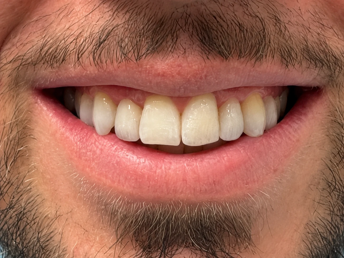 Sorriso dopo: confronto faccette no prep in ceramica