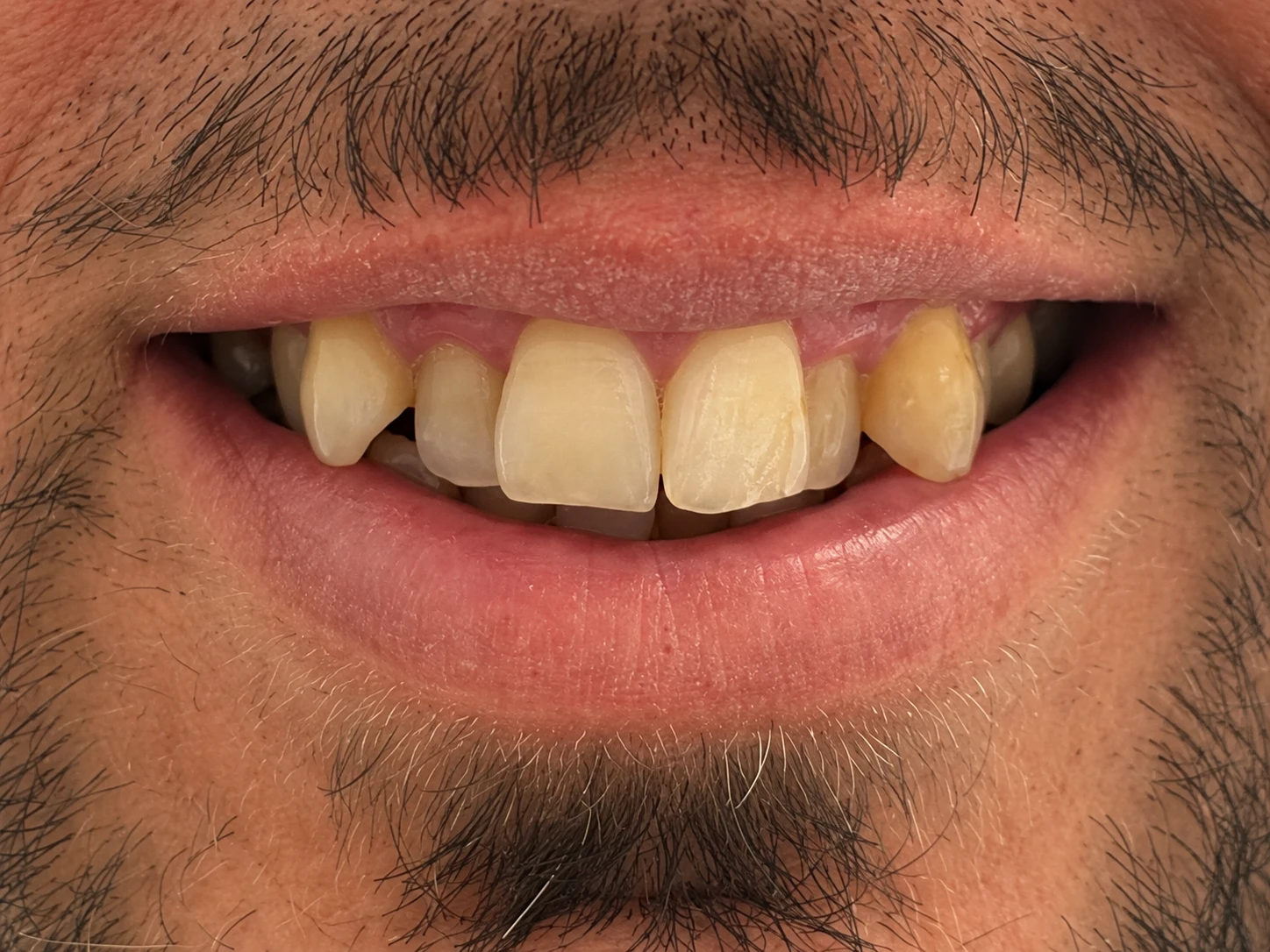 Sorriso prima: confronto faccette no prep in ceramica