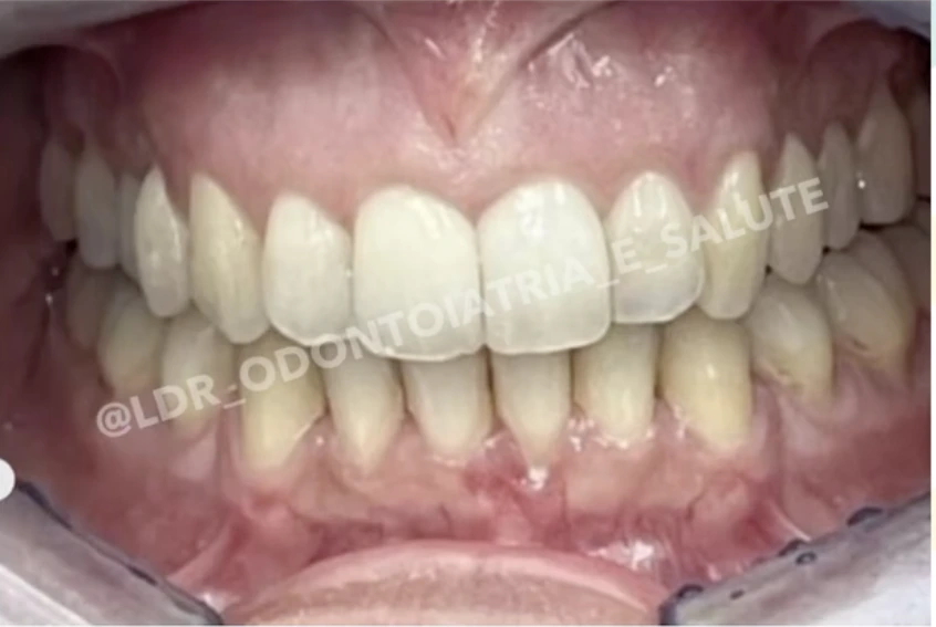 Risultato di trattamento ortodontico con allineatori
