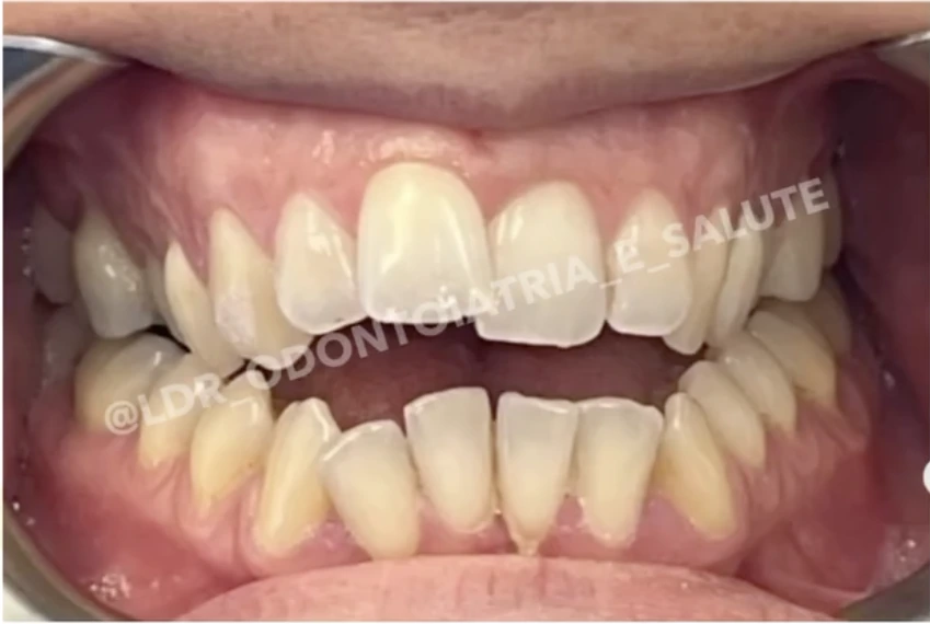 Situazione iniziale prima del trattamento ortodontico con mascherine invisibili