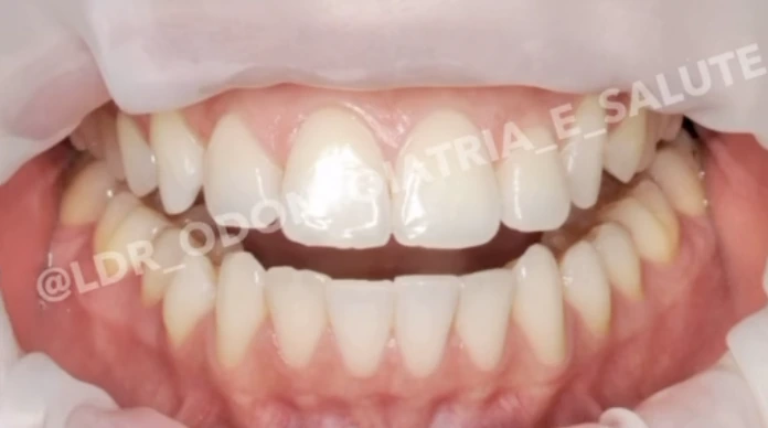 Fotografia del risultato di sbiancamento domiciliare con mascherine su misura
