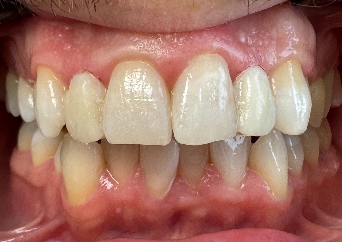 Risultato finale dopo il trattamento estetico dentale