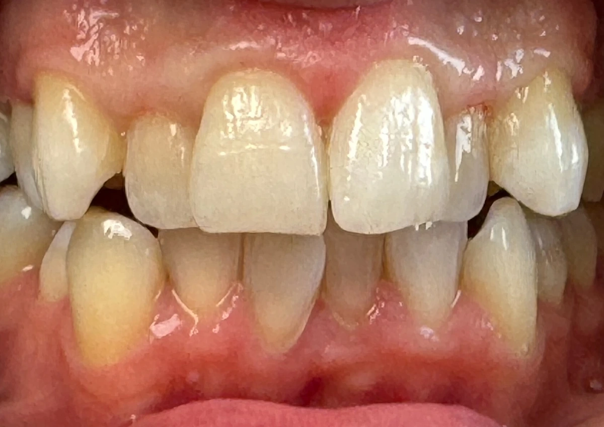 Situazione iniziale prima del trattamento estetico dentale
