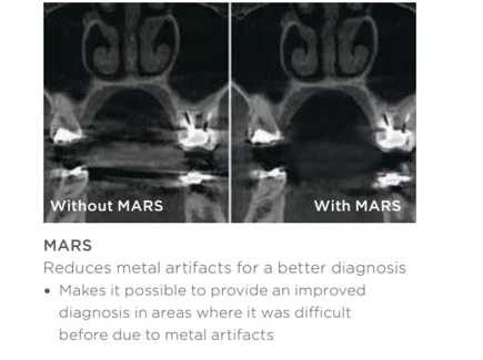 Confronto MARS per la riduzione degli artefatti da metallo